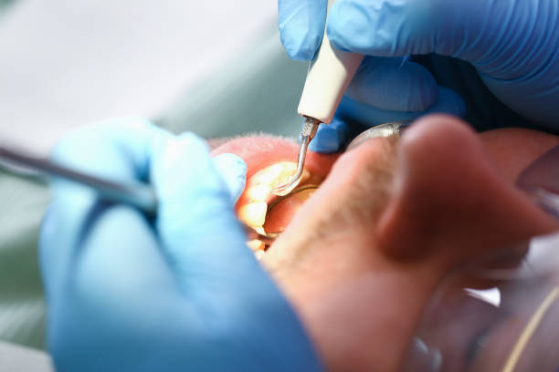 Best Emergency Treatment for Dental Infections or Abscesses in Darby, PA